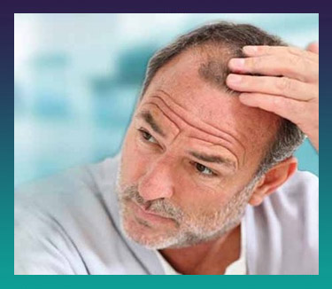 Hair Transplant